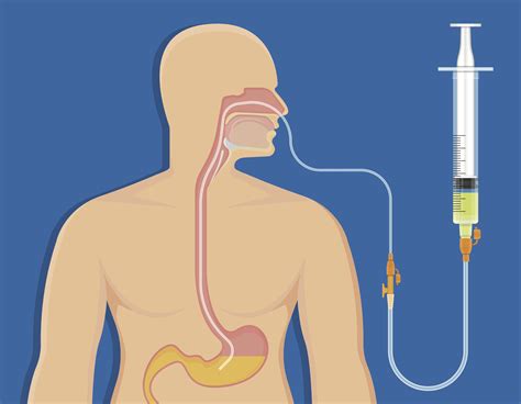 NASOGASTRIC TUBE IN ADULT PATIENTS .